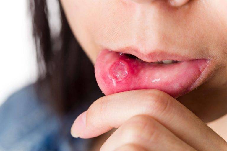 mouth sore on woman's lip from chemo